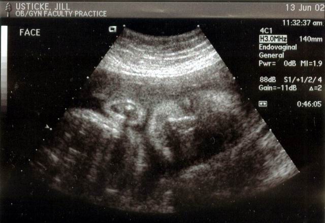 30+weeks+pregnant+ultrasound